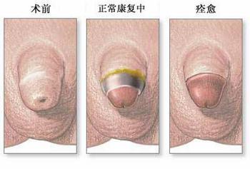 包茎会给男性带来哪些伤害